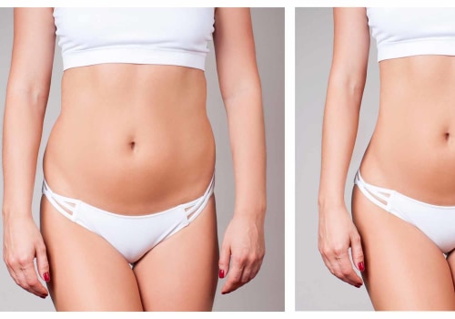 How Long Do the Results of Fat Reduction Treatments Last?